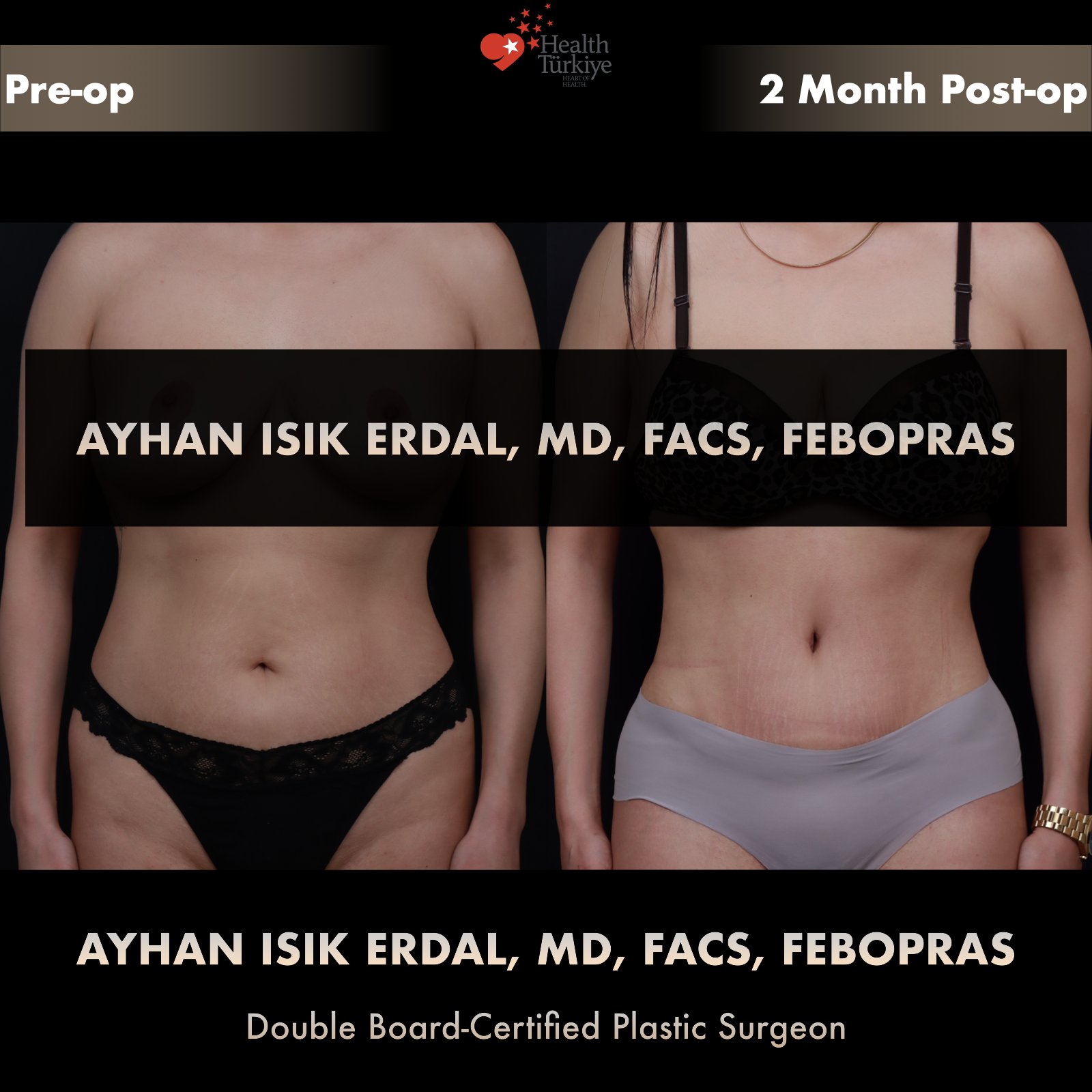 Standard abdominoplasty with rectus plication — frontal comparison at 2 months post-op