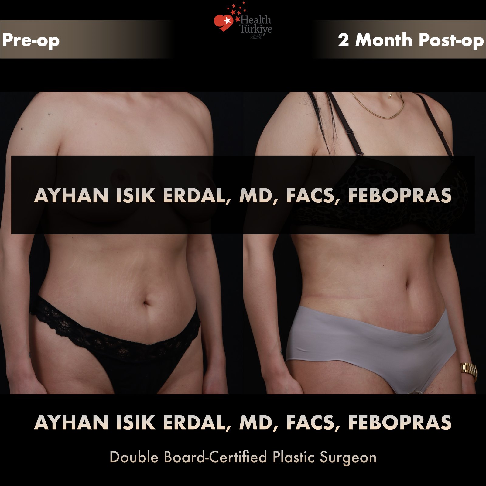 Standard abdominoplasty — oblique comparison at 2 months post-op