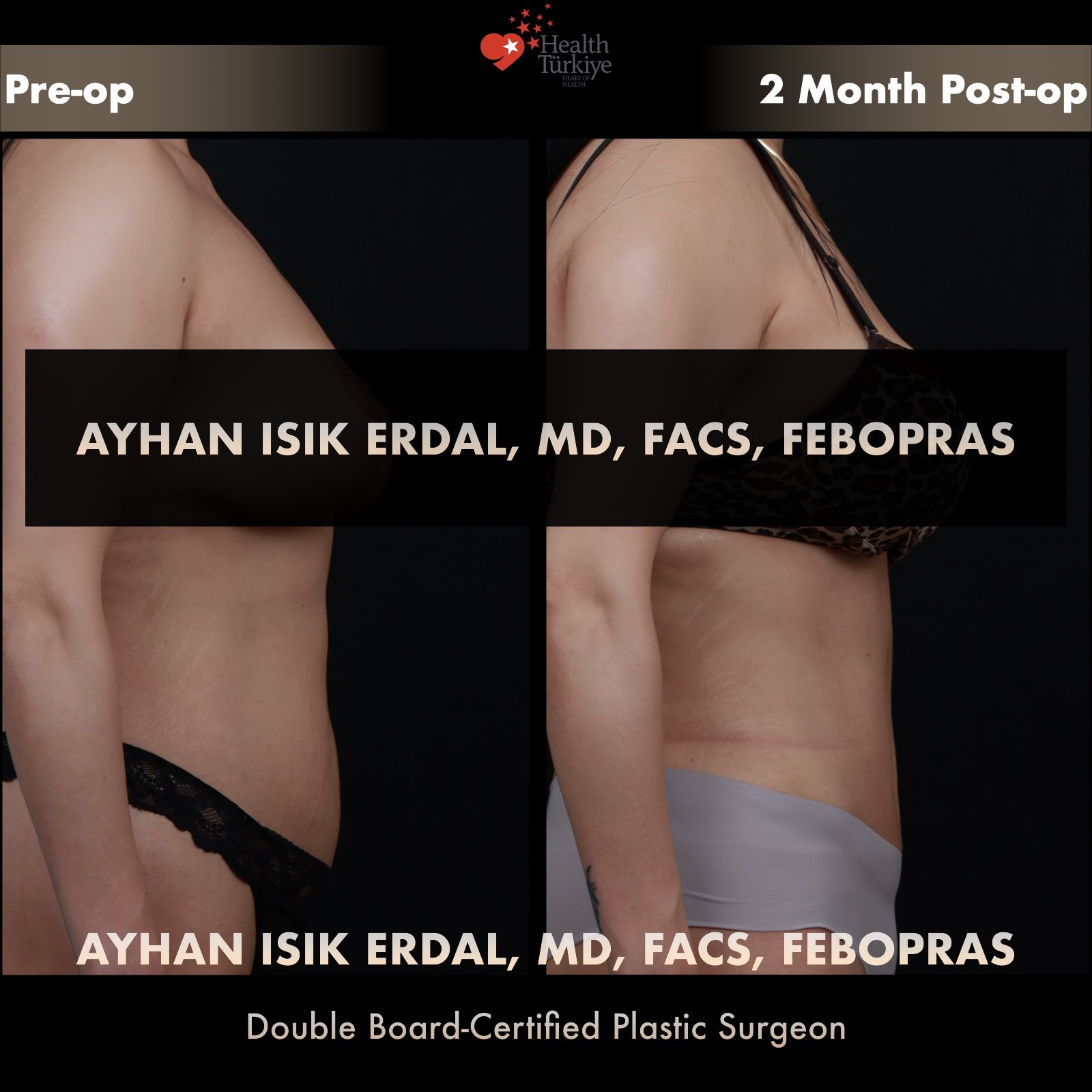 Standard abdominoplasty — lateral comparison at 2 months post-op