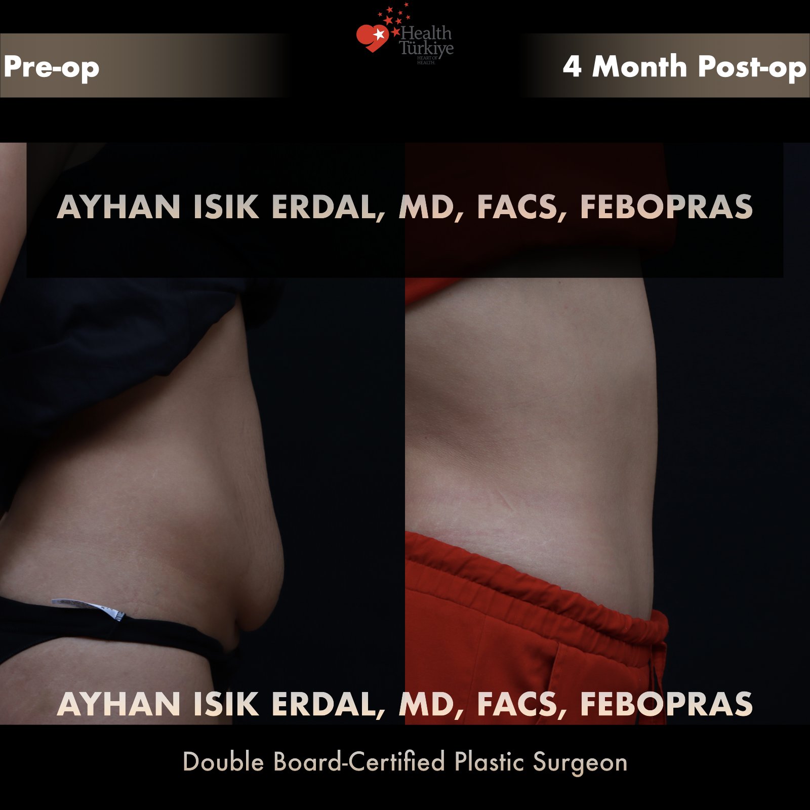 Post-partum standard abdominoplasty — oblique comparison at 4 months post-op