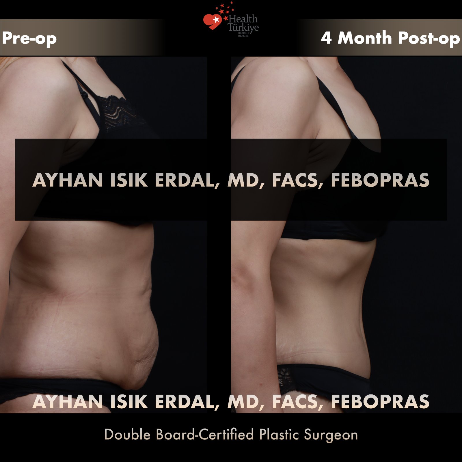 Standard abdominoplasty — lateral standing comparison at 4 months post-op
