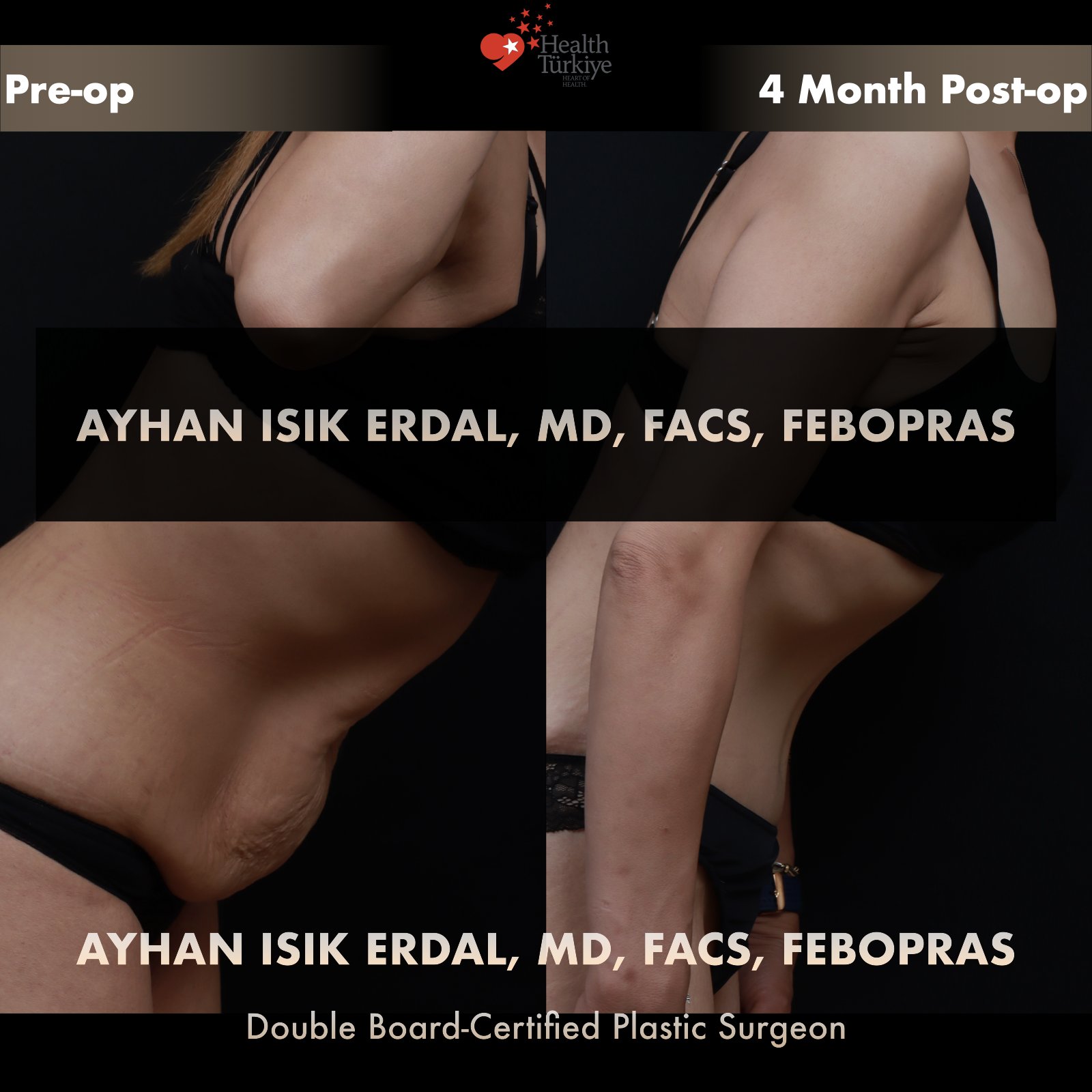 Standard abdominoplasty — lateral forward-bending comparison demonstrating pre-operative dynamic laxity at 4 months post-op